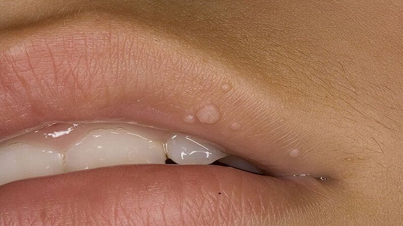 Papilloma on the lip
