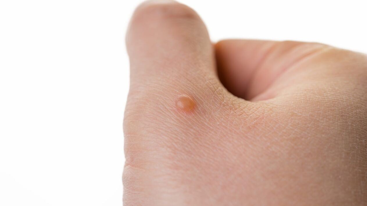 Neophages on the arm