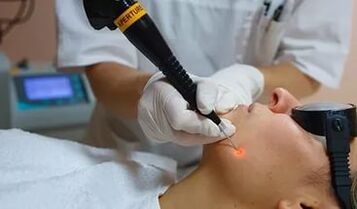 An effective procedure for removing papillomas on the face using a laser