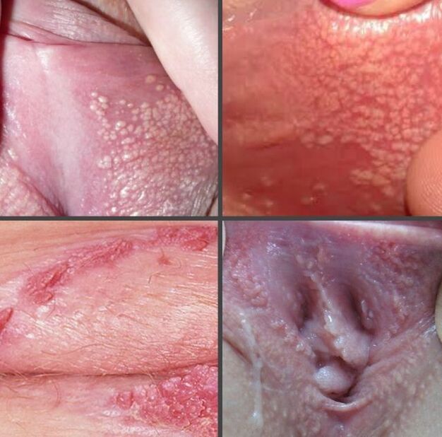 What do papillomas look like on the labia