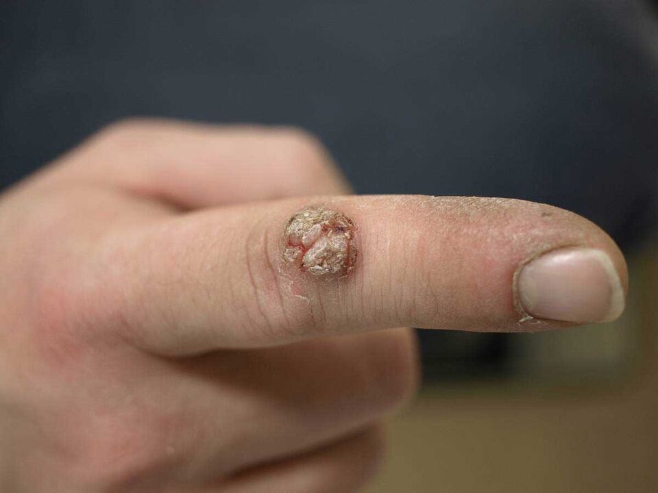 Large wart on a finger that needs to be removed