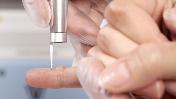 One of the methods for removing warts is using a laser