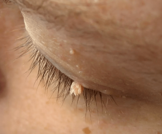 Film Papillomas