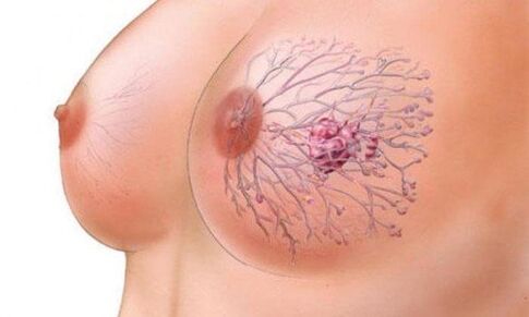 Papilloma of the chest