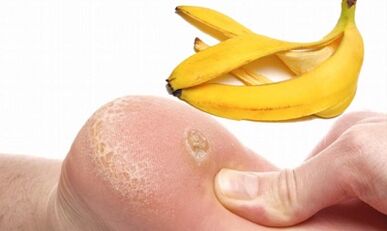 Banana tray for the treatment of a plantar farm