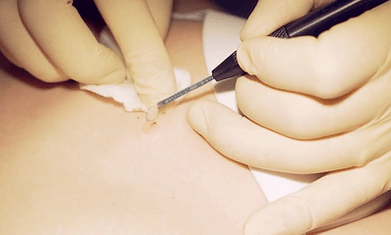Surgical removal of the plantar farm