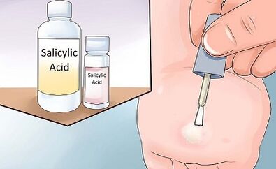 How to get rid of papillome folk paths