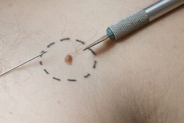 Wart removal methods
