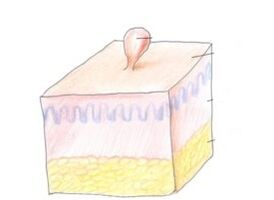 how to get rid of papillomas on the body