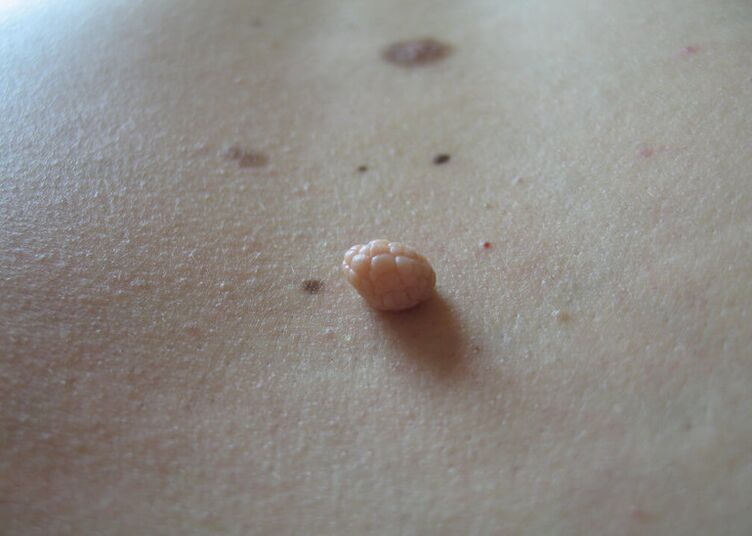 Papillomas on the human body