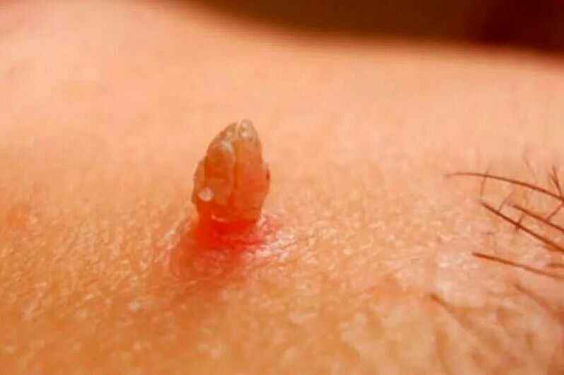 Genital warts on the body