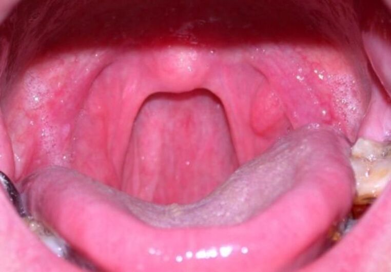Papillomas in the throat