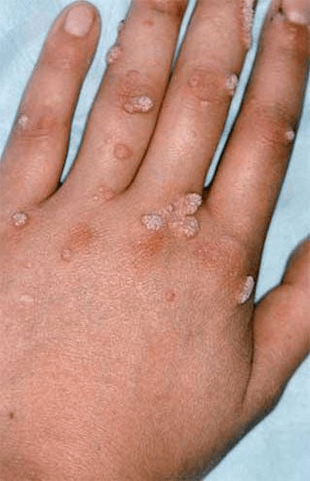 Papillomas on the hand