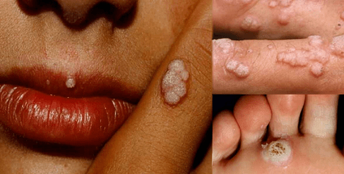 Papillomas throughout the body