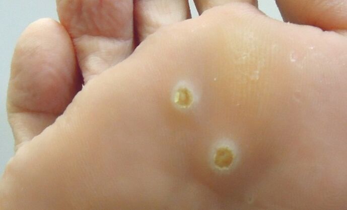 Plantar papillomas on the foot