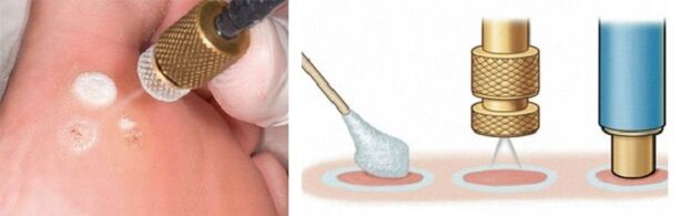 Cryodestruction as a method for removing papillomas