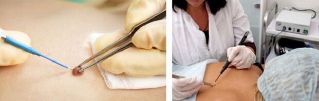 Electrocoagulation to remove papillomas