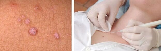 Professional removal of papillomas on the body
