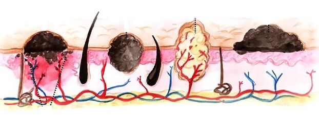 Types of papillomas on the human body