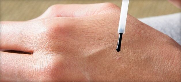 Treating warts with medication