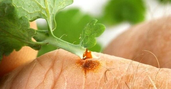 Treatment of warts with celandine