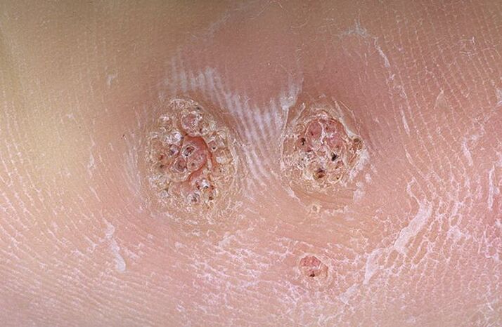 Warts on the body