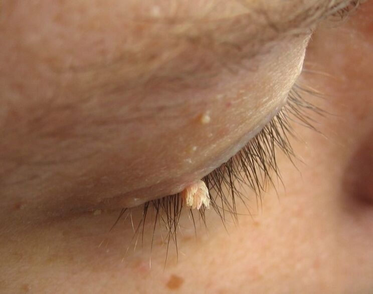 Condyloma on the eyelid