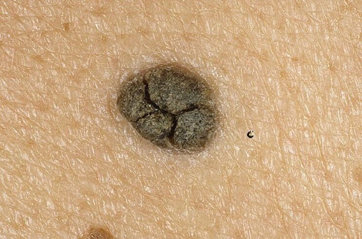 Keratoma on the skin of the body