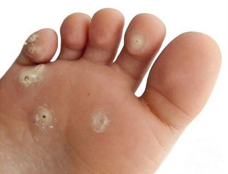 Plantar wart