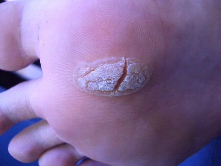 Wart on the skin of the foot