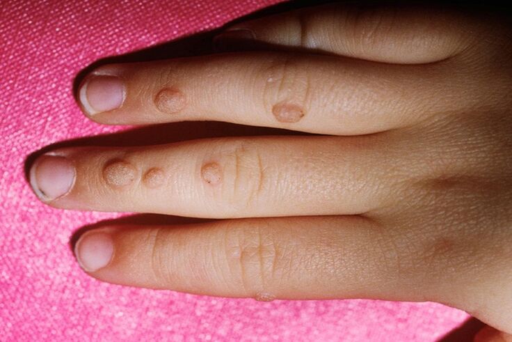 common warts on the fingers