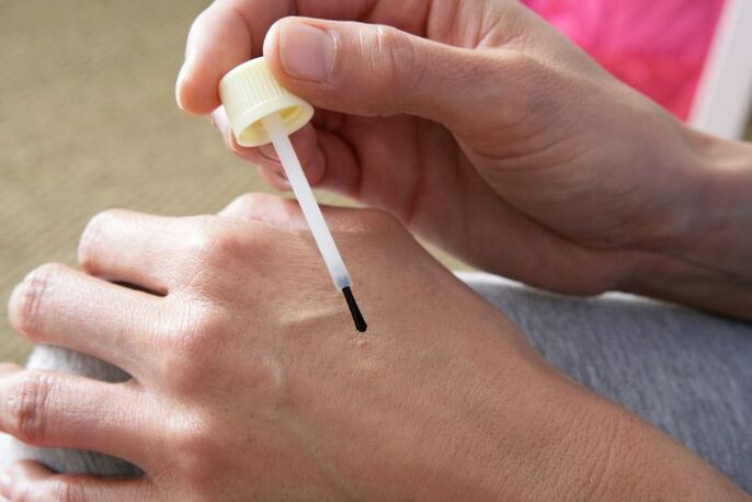 Cauterizing warts with celandine juice