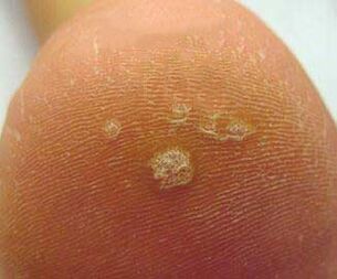 first symptoms of warts